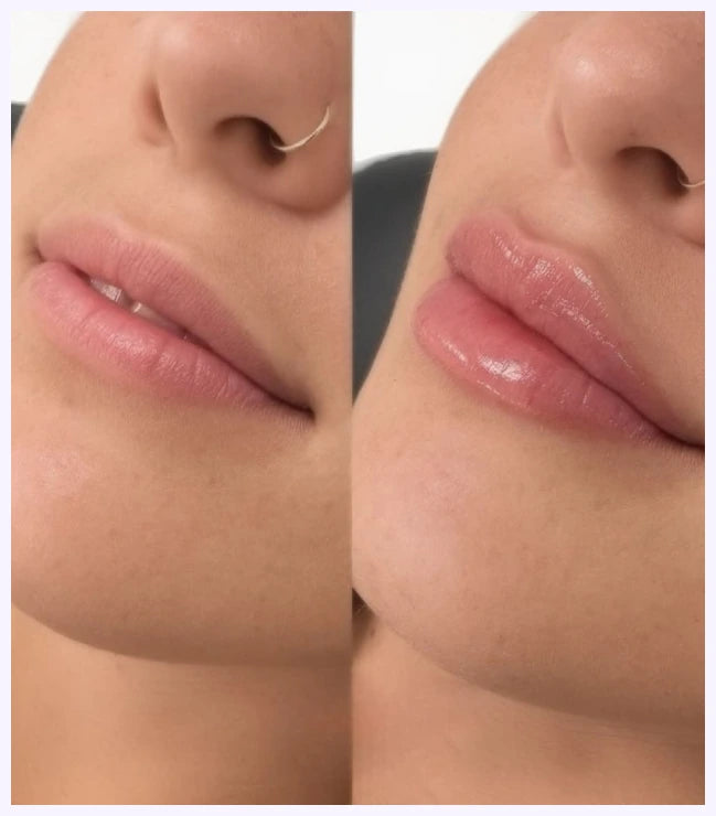 Lip Filler Special – $100 OFF