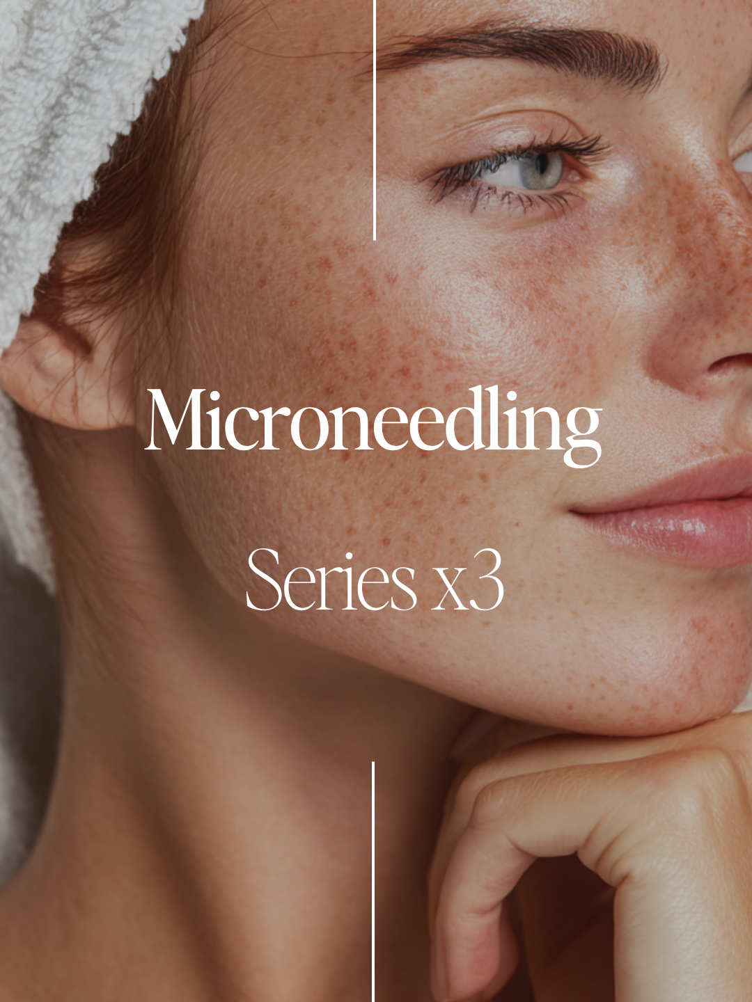 Post-Summer Skin Reset – 3 Microneedling Sessions